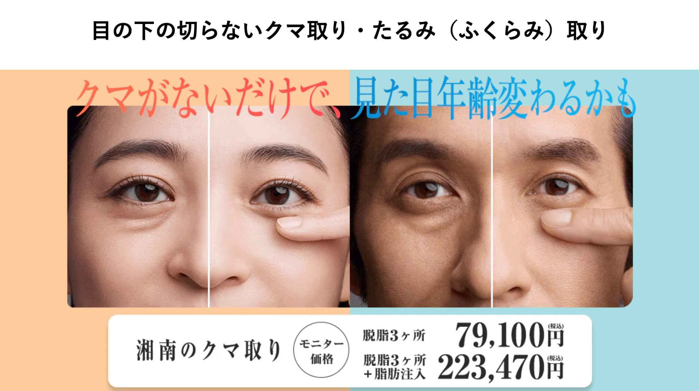 SBC湘南美容クリニックのクマ取りは1回の施術で完結したいという男性へ